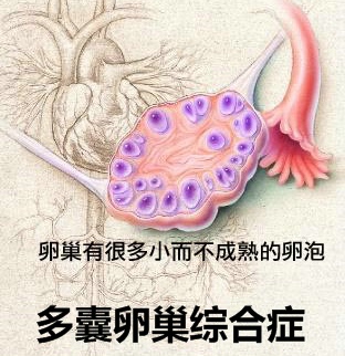 什么是多囊卵巢综合征？