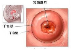 治疗宫颈糜烂究竟要多少钱?