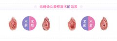 宿州做处女膜修复手术怎么样?