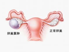 宿州治疗卵巢囊肿多少钱?