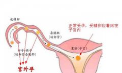怀孕早期肚子痛是宫外孕吗?